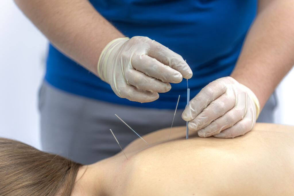 acupuncture
