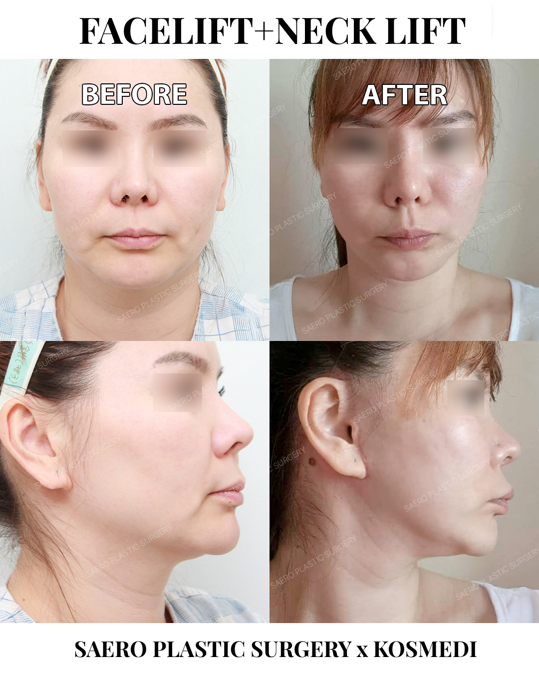 Deep Plane vs Endoscopic Facelift in Korea: Scar Guide