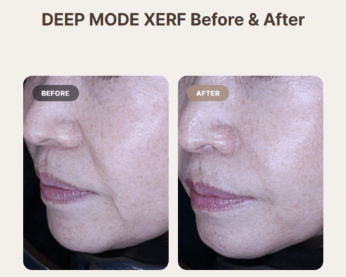 XERF vs Ultherapy: Pain and Before & After Results in Korea