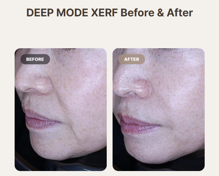 Ode Clinic Deep Xerf Mod Before & After Treatment