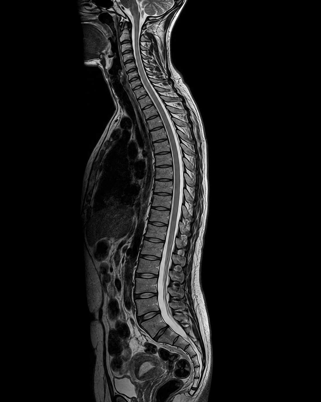 spine mri